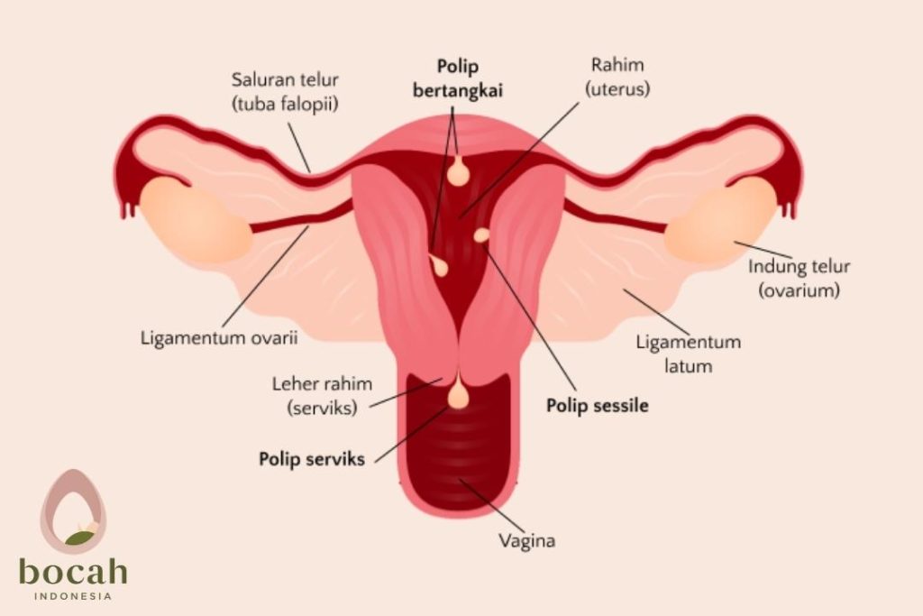 gambar polip rahim dan serviks