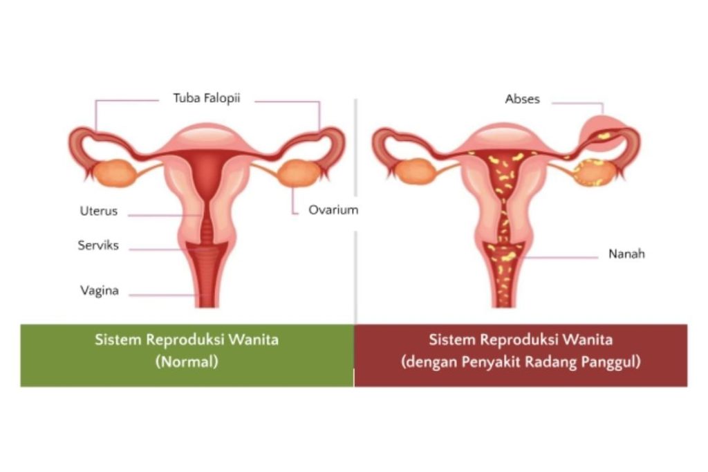 gambar perbandingan penyakit radang panggul