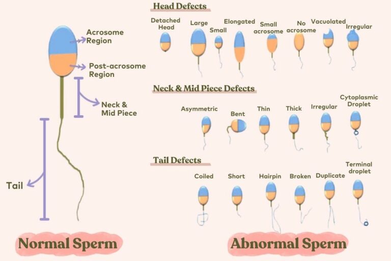 Teratozoospermia sperms