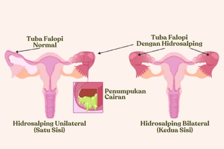 hidrosalping bilateral dan unilateral