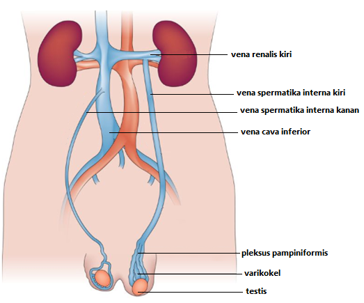 varikokel