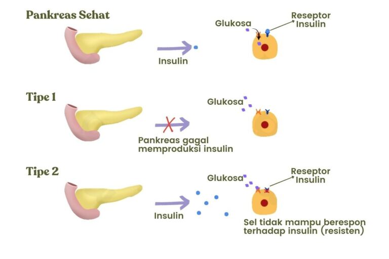 Tipe-tipe diabetes