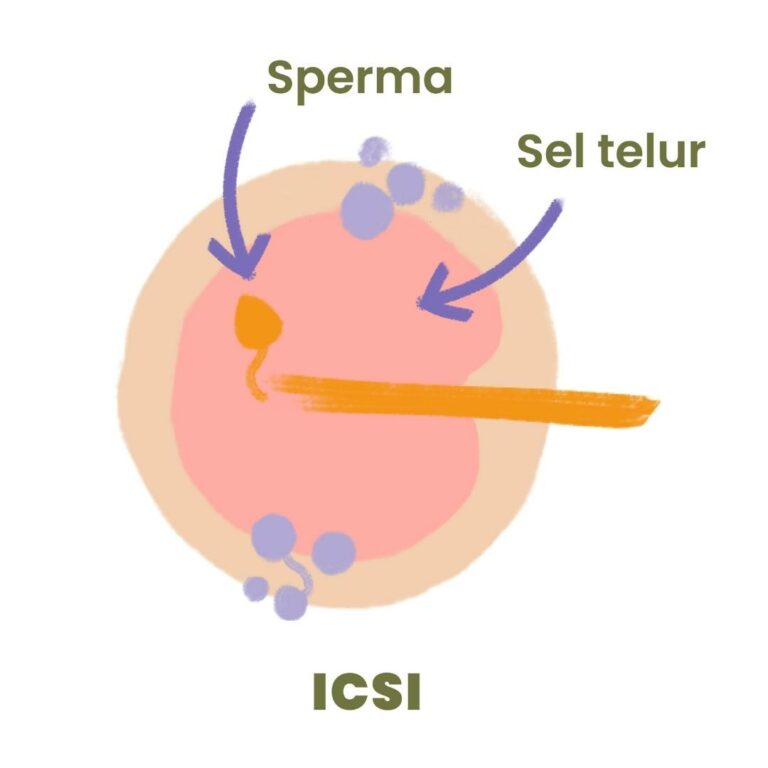 Prosedur ICSI