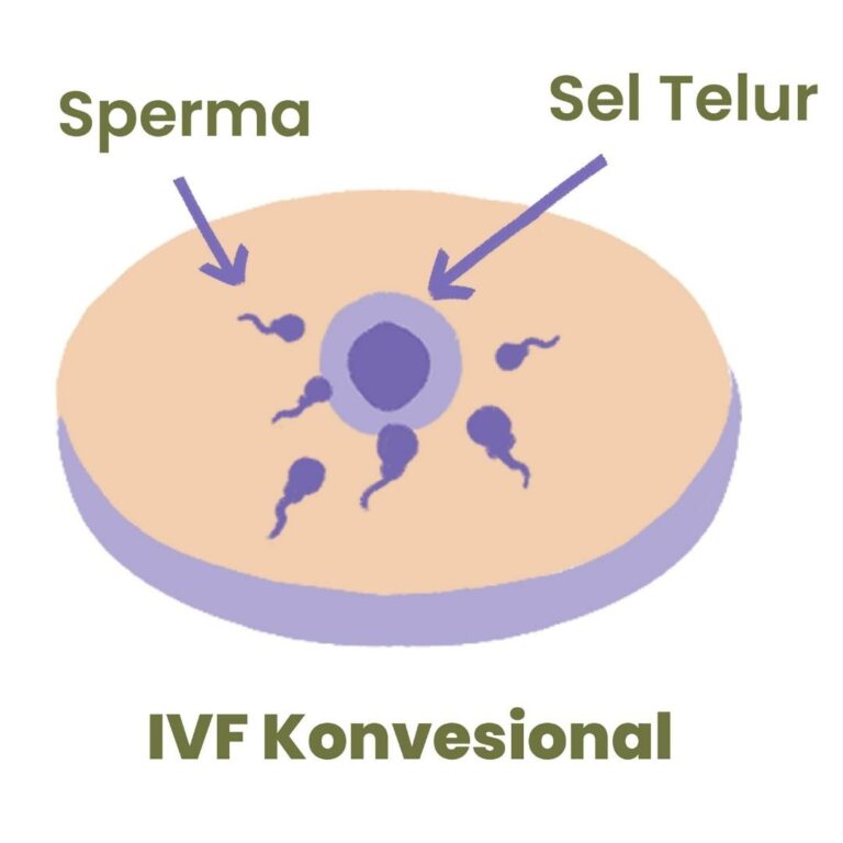 Prosedur IVF Konvensional