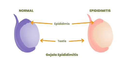 epididimitis adalah