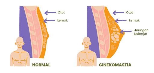 Ginekomastia adalah