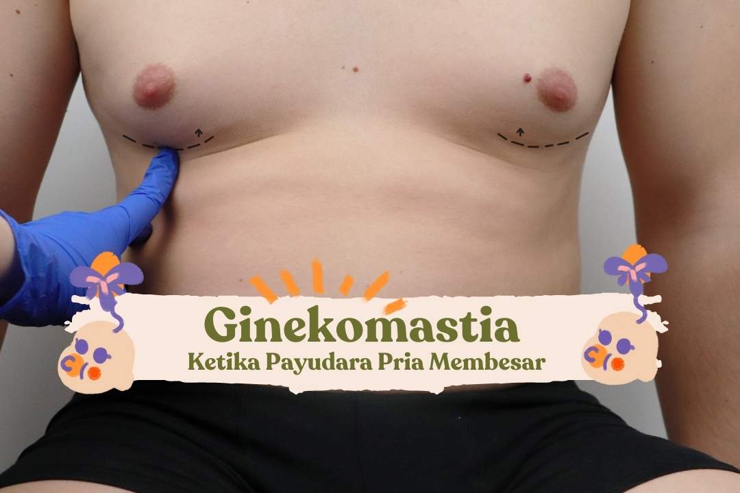 GInekomastia