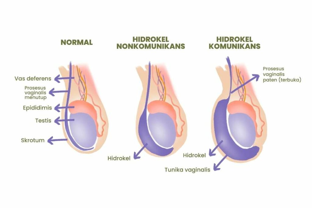 Hidrokel