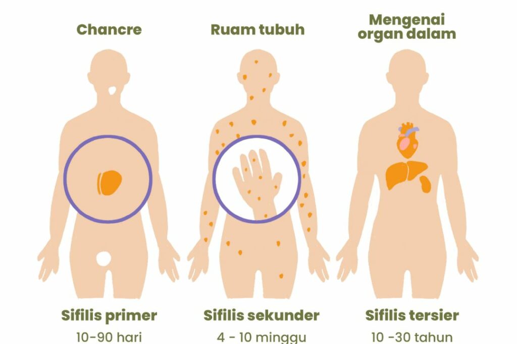 tahapan-penyakit-sifilis