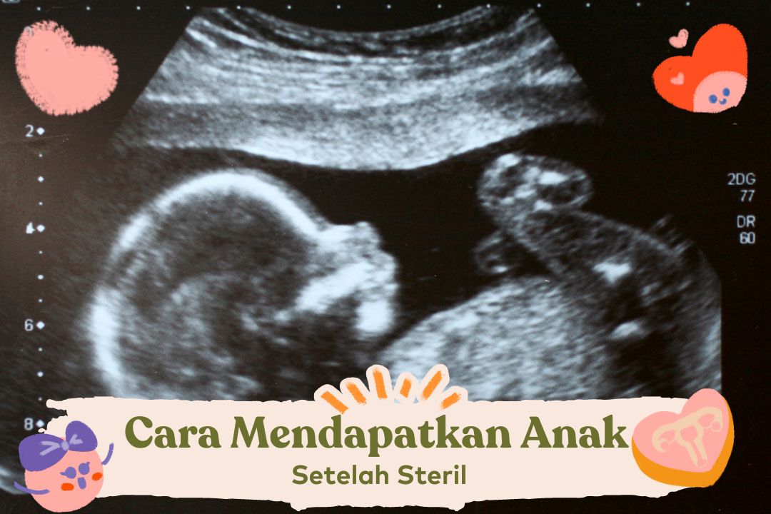 Cara Mendapatkan Anak Setelah Steril