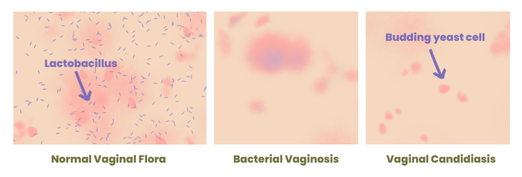 Cytolytic Vaginosis