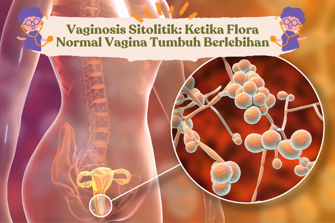 vaginosis sitolitik