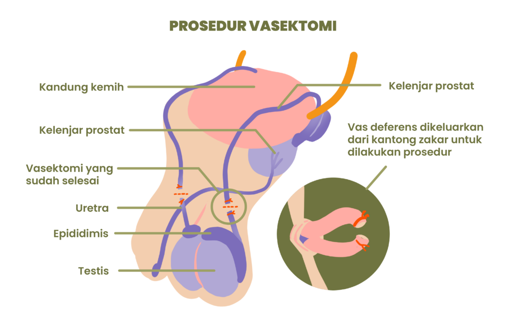 vasektomi