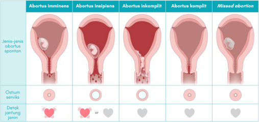 abortus imminens