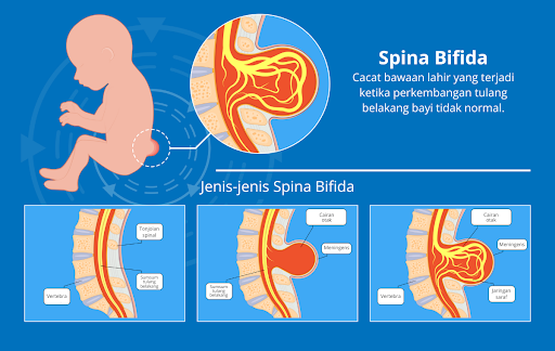 spina bifida