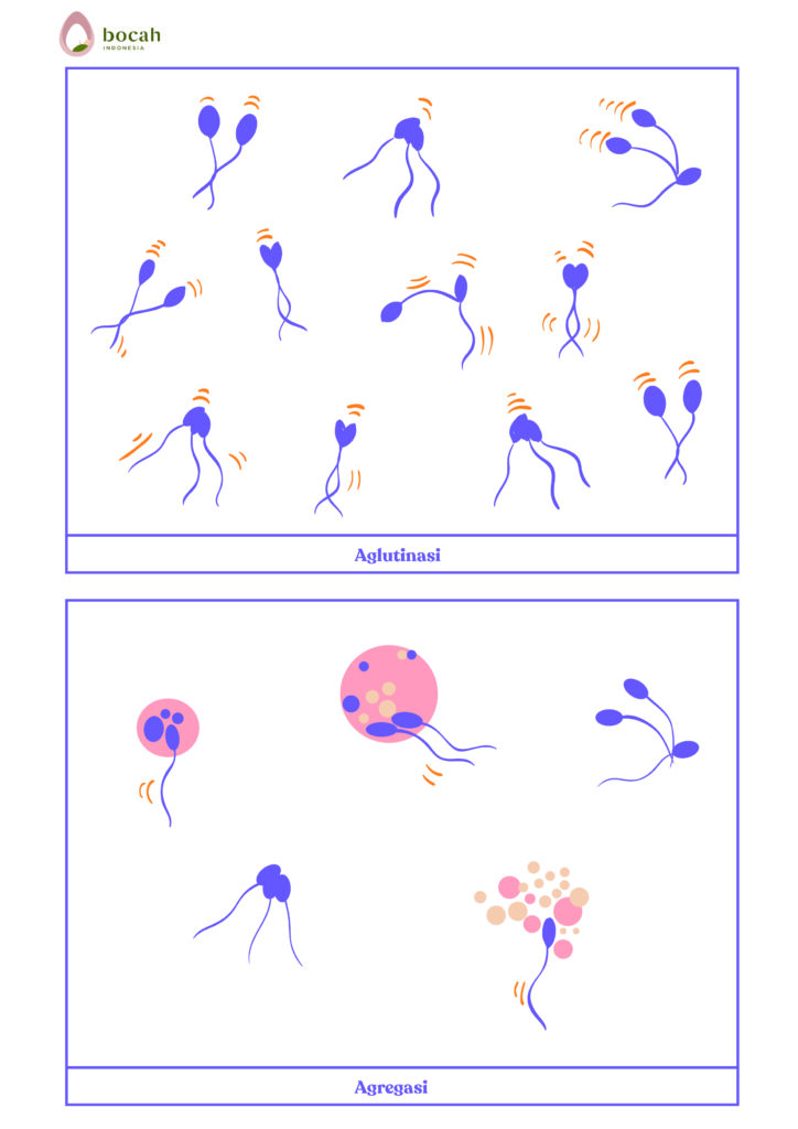 Aglutinasi vs Agregasi sperma