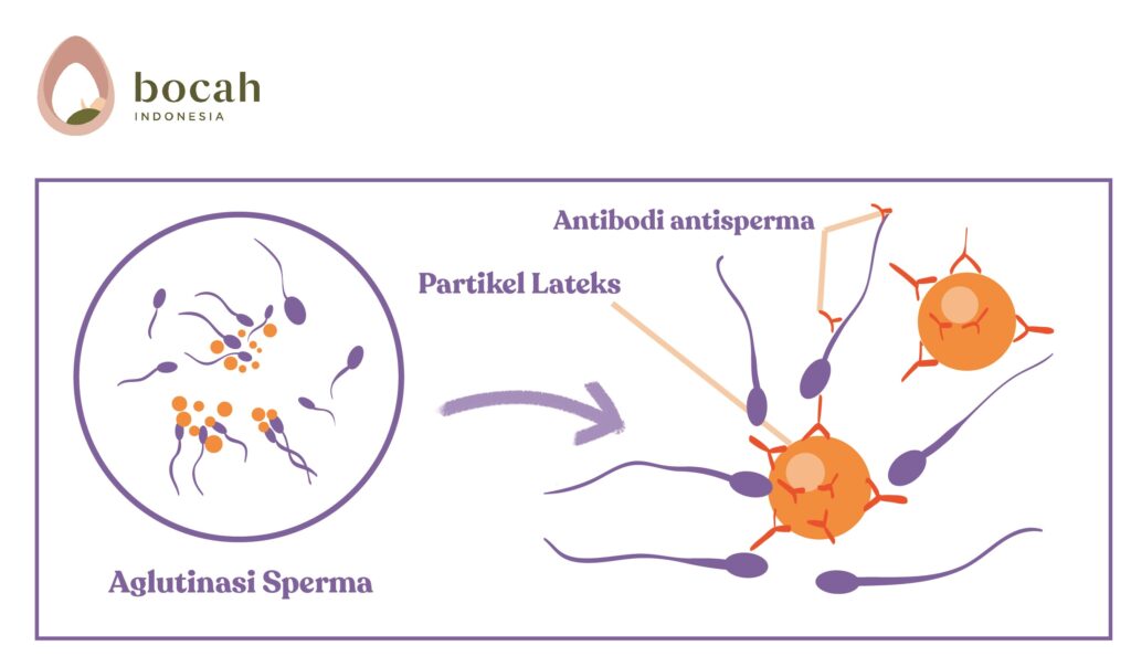 Penyebab Aglutinasi Sperma