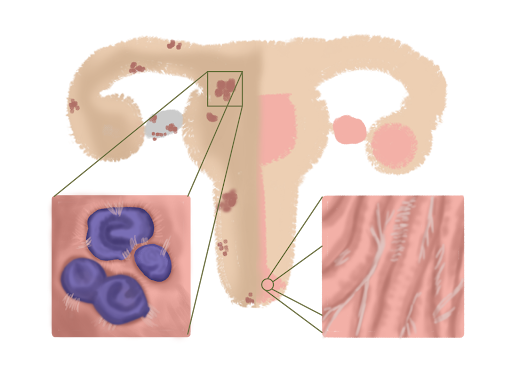 Gejala adhesi pelvis