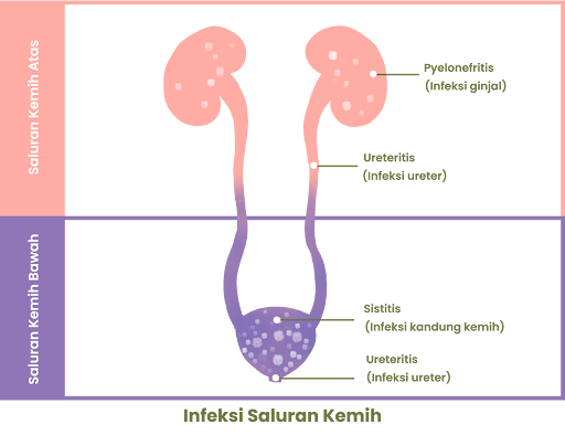 Infeksi Saluran Kemih