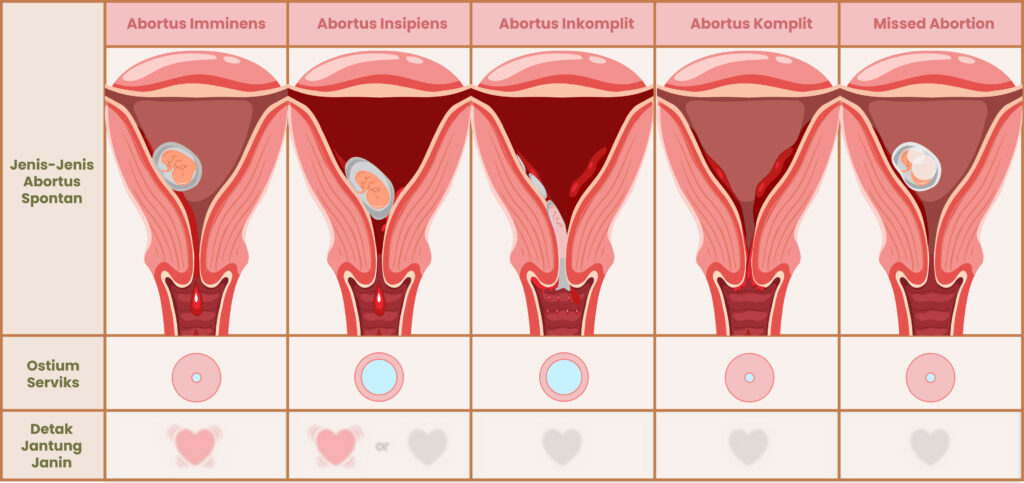 Jenis Jenis Abortus optin
