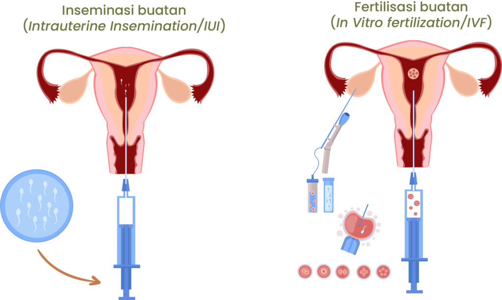 Fertiliasasi buatan